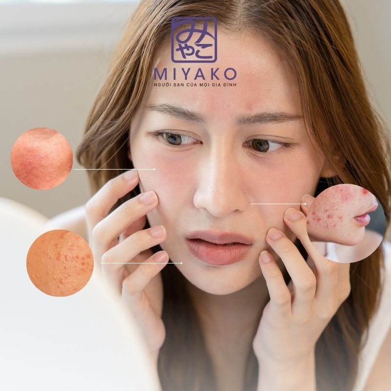 Da dễ kích ứng – nỗi khổ thường gặp khi hè đến và cách chăm sóc đúng cách