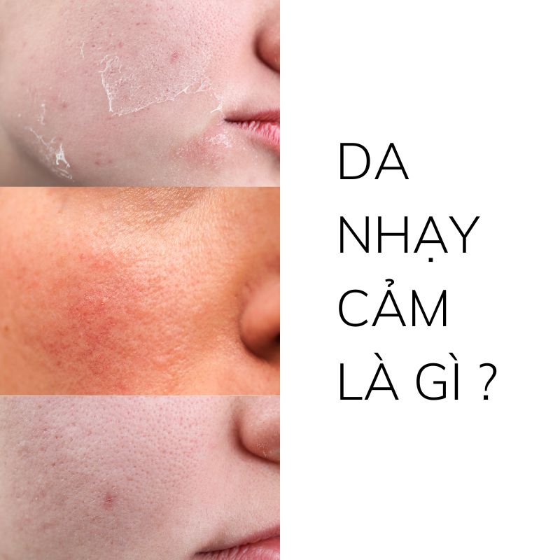 Da nhạy cảm là gì ?